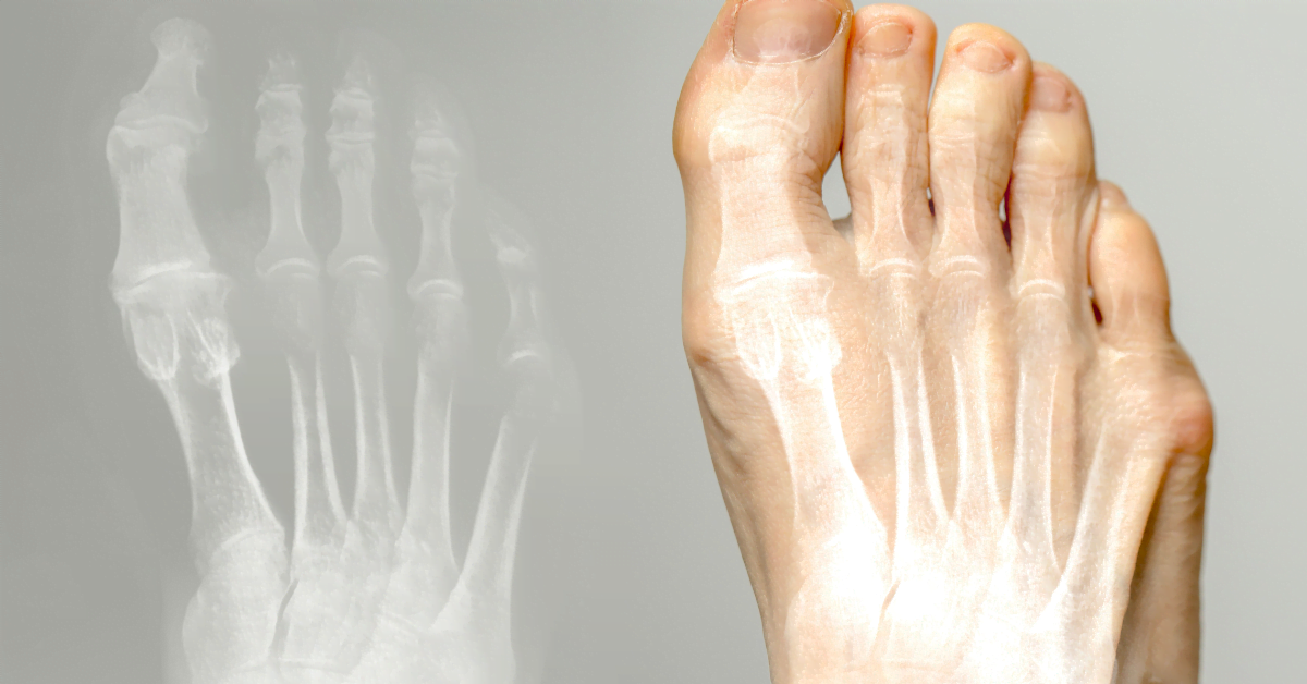 Traitement du hallux valgus – séparateur d’orteils et chaussures