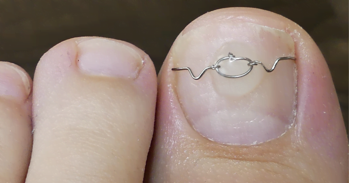 Ongle incarnée – traitement et prévention