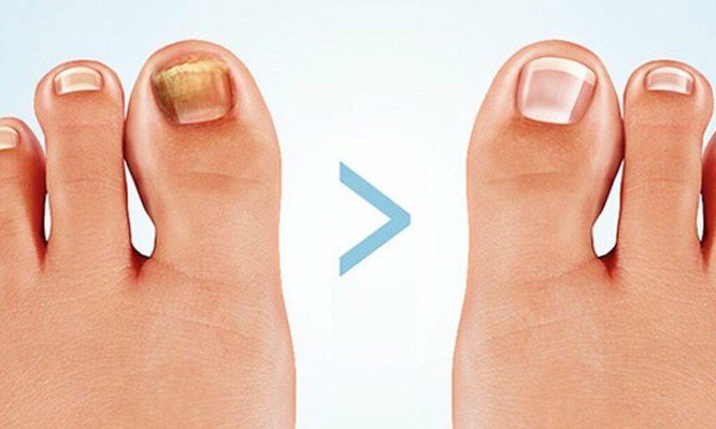 Kalknagel behandelen