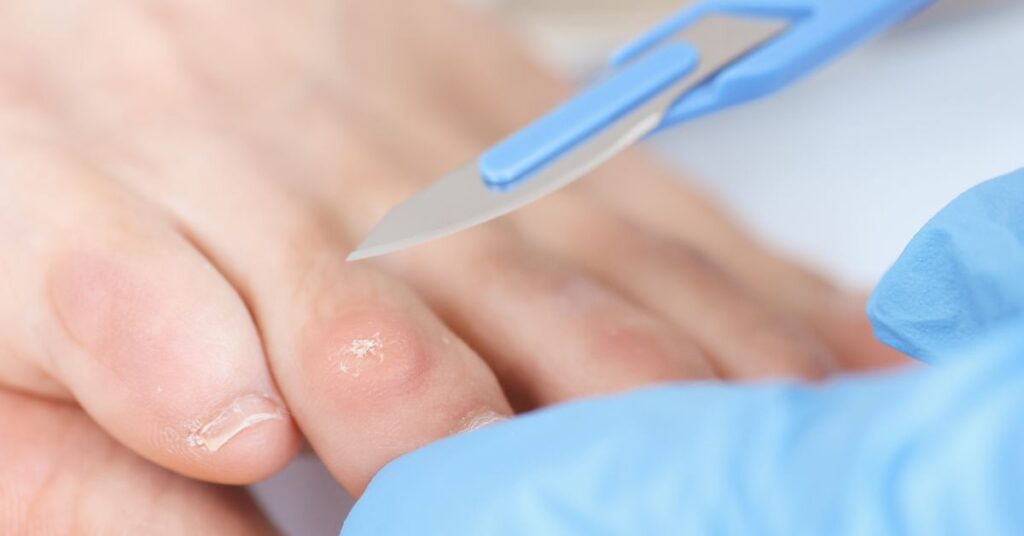 Cor – œil de perdrix sur le pied