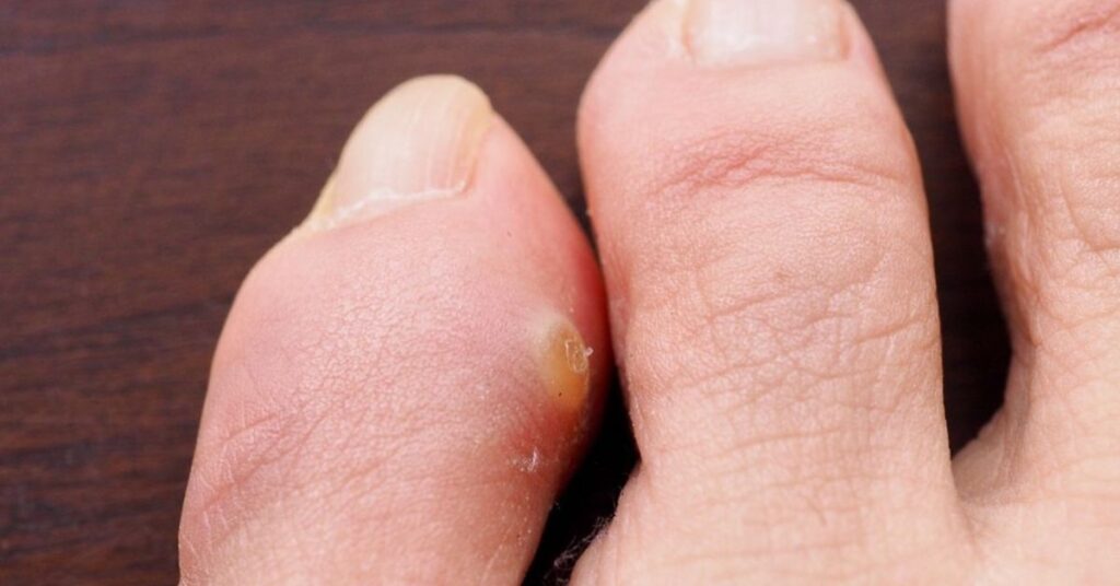 Traitement du cor – pédicure et prévention