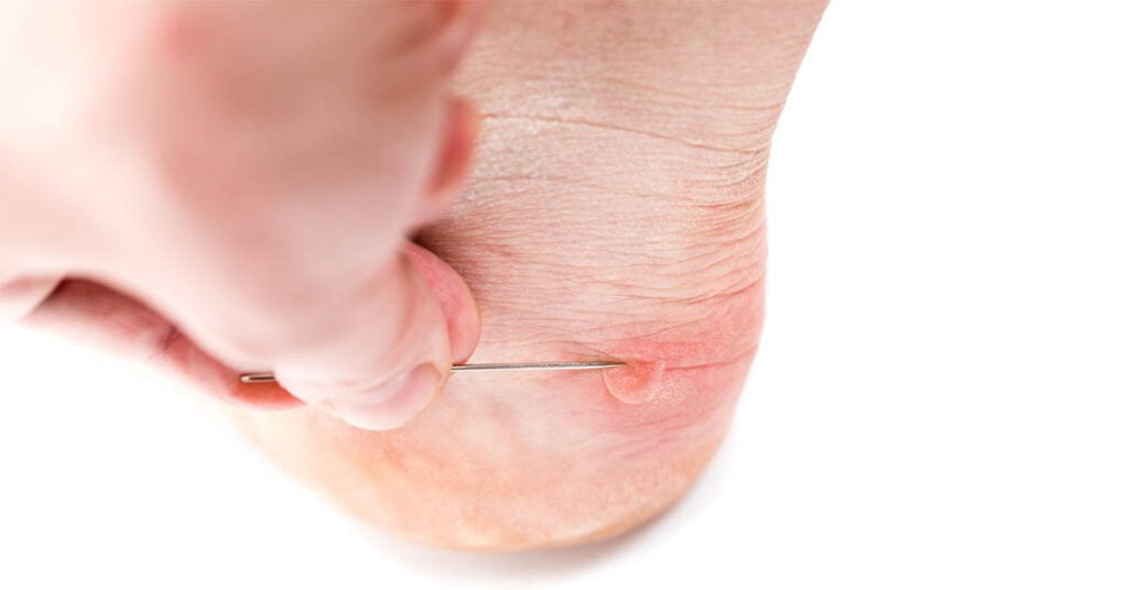 Percer une ampoule au pied – travailler de façon stérile avec une aiguille ou un perce-ampoule